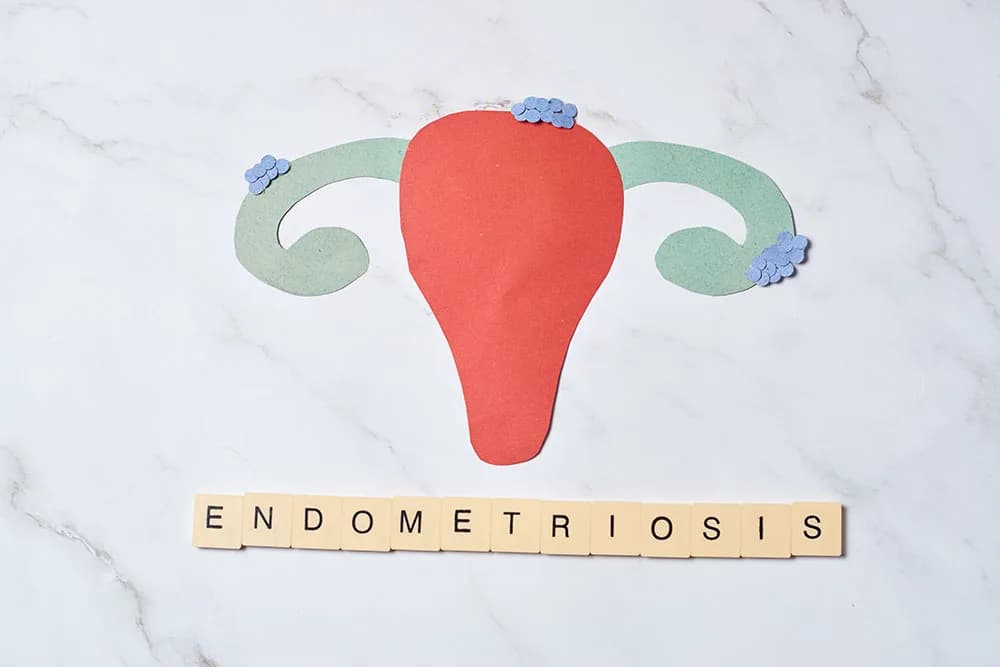 Endometriosis: Symptoms, Diagnosis, and Treatment